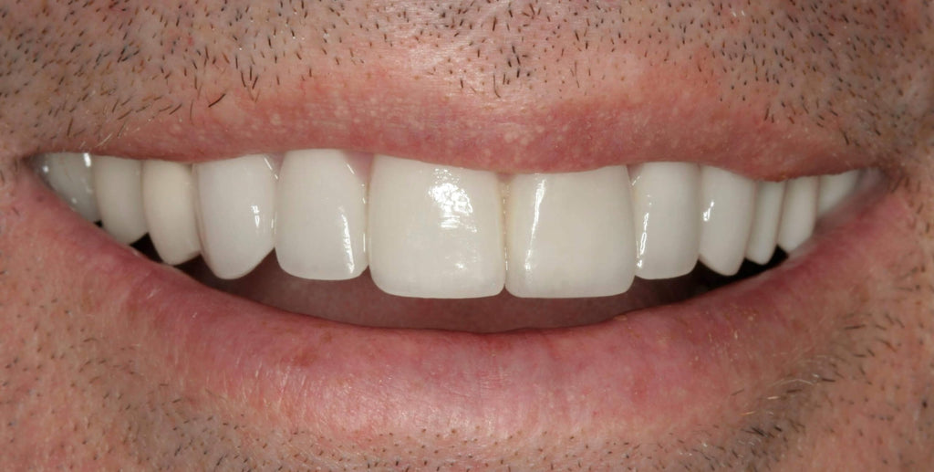 Customizable Dentures Kit with 12 Pieces M331